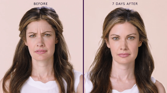 botox before and after (f9625f78-4a5f-4d7a-a7a4-f3bc7d95e5b3)